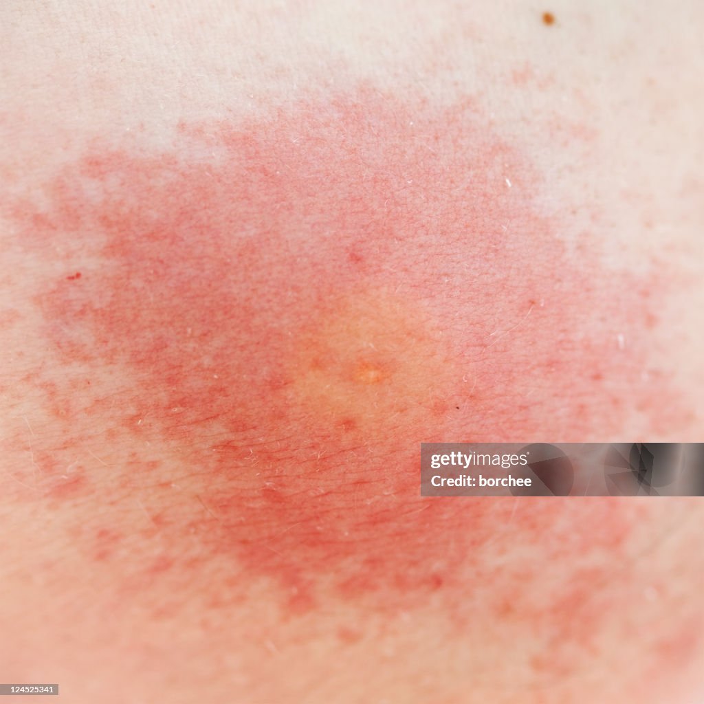 Wespe Sting Allergie