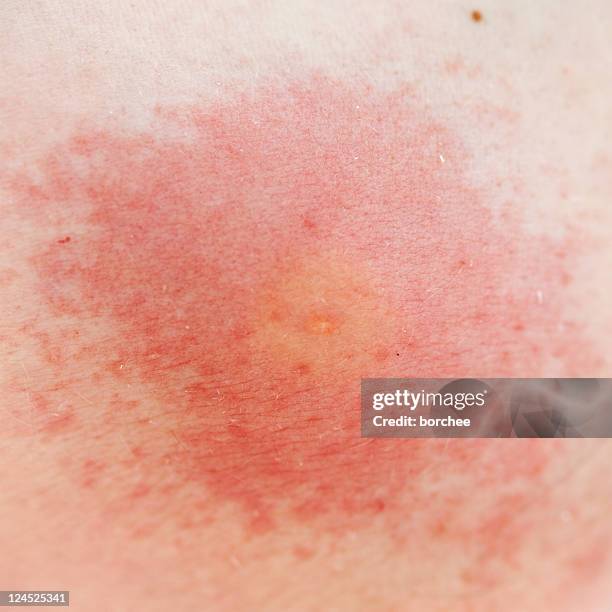 wasp sting allergy - stinging stock pictures, royalty-free photos & images