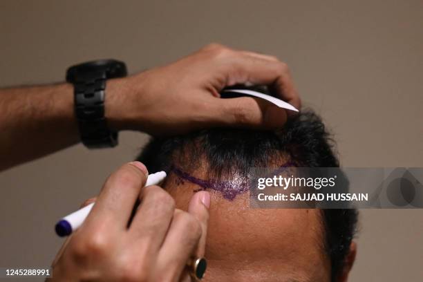 In this photograph taken on November 5 Dr. Mayank Singh makes hairline markings on the scalp of a hair transplant patient at Crown clinic in New...