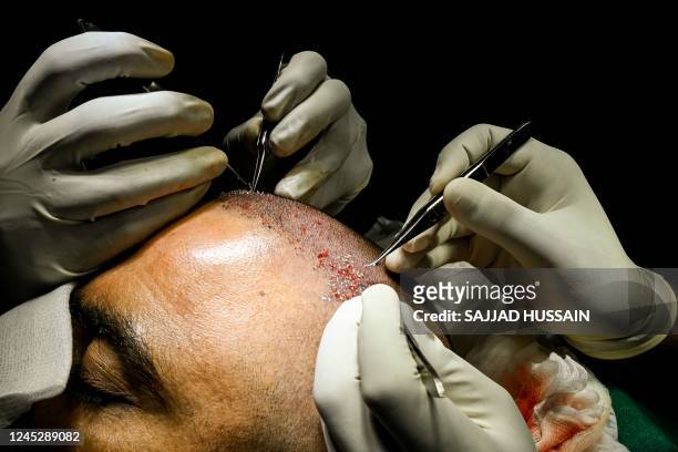 551 Hair Transplant Photos and Premium High Res Pictures - Getty Images