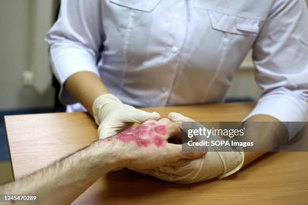 Rash Cast A student examines the