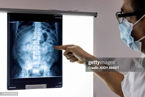 This photograph taken on October 14 shows Dr Karim Hamiche, doctor in charge of the UMJ , at the hospital in Cayenne, looking at an abdominal X-ray,...