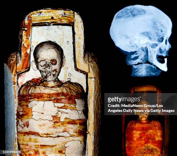 September 10: Images of CT scans revealed that this person had only one remaining tooth and a loss of bone mass in the lower jaw-probable due to old...