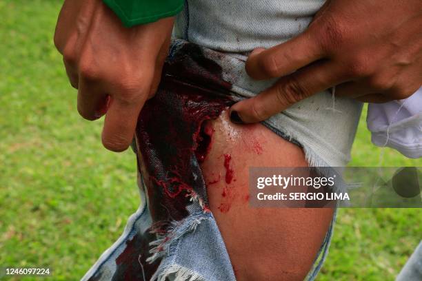 Supporter of Brazilian former President Jair Bolsonaro shows a wound during clashes with riot police outside Planalto Presidential Palace in Brasilia...