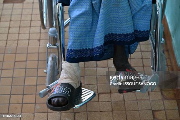 Woman who has leprosy is seen at the Raoul Follereau Institute near Adzope on January 25, 2023. - Listed by the WHO as one of the 20 neglected...