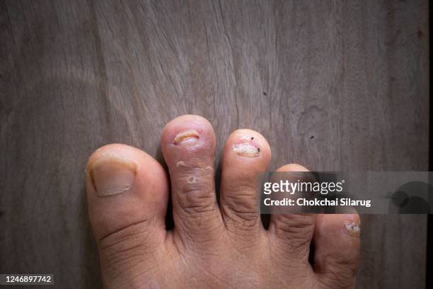 close up of nail fungus, toe fungus, foot dermatitis - psoriasis fotografías e imágenes de stock