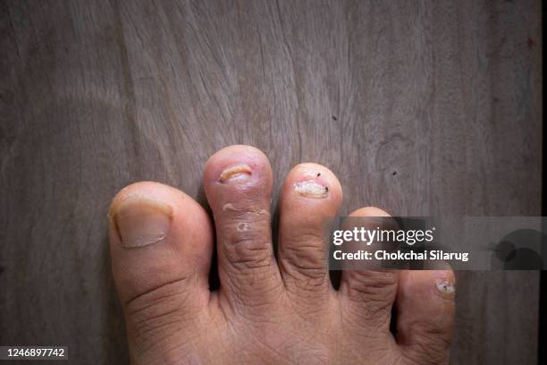 close up of nail fungus, toe fungus, foot dermatitis - onicomicosi foto e immagini stock