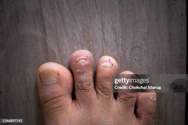 close up of nail fungus, toe fungus, foot dermatitis - candida albicans 個照片及圖片檔