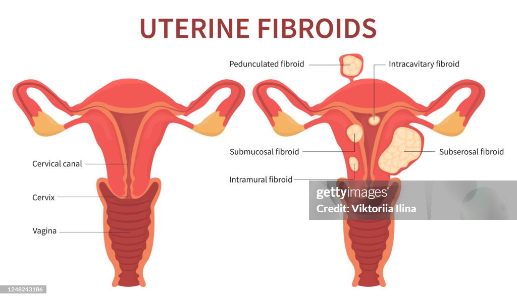 Fibrot Woman Uterine Fibroids Diagram On White Background High-Res Vector ...