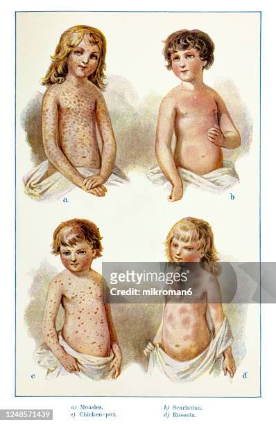 old engraved illustration of infectious disorders, childhood infectious diseases - chickenpox stock pictures, royalty-free photos & images