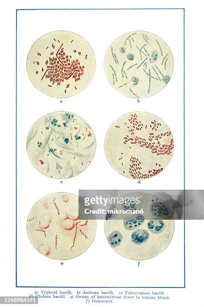 old engraved illustration of catarrh of the bladder - salmonella bacteria fotografías e imágenes de stock