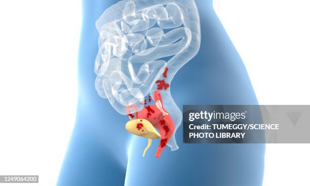 endometriosis, 3d illustration - human tissue stock illustrations