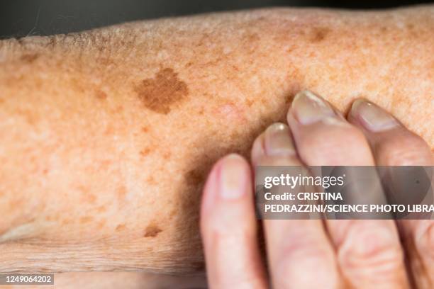 liver spots on elderly skin - lentigo stock pictures, royalty-free photos & images