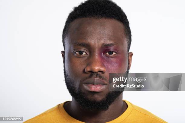 portrait of an african-american man, victim of racist violence - machucado imagens e fotografias de stock