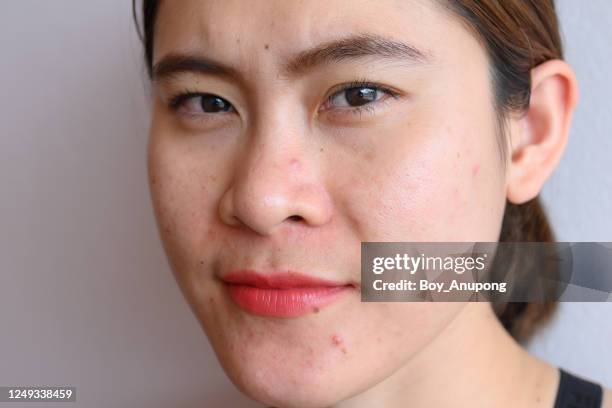 portrait of asian woman with acne problem occur on her face. - very ugly women - fotografias e filmes do acervo