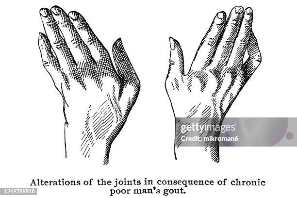 old engraved illustration of various types of diseases of the bones and joints - gout stockfoto's en -beelden