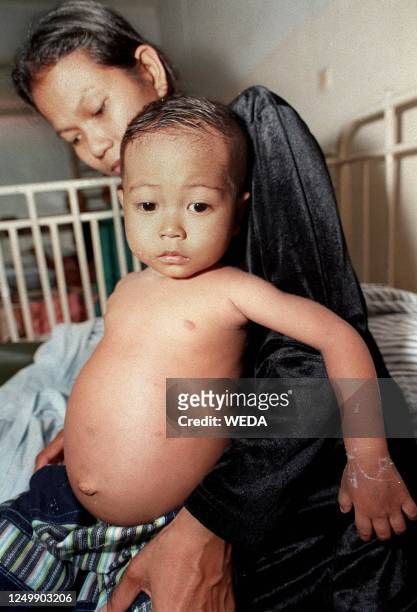 An Indonesian woman holds her chronically under-nourished child, a condition caused by a diet deficient in calories and protein, at the Tangerang...