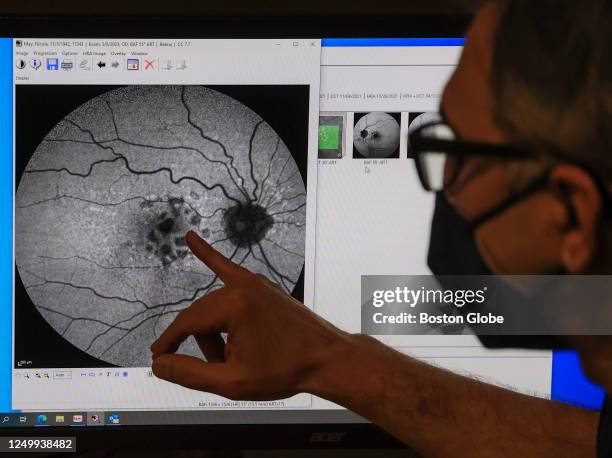 Dr. Jeffrey S. Heier, at Ophthalmic Consultants of Boston, pointing at a picture of a patients left eye where the black areas are coalescing around...