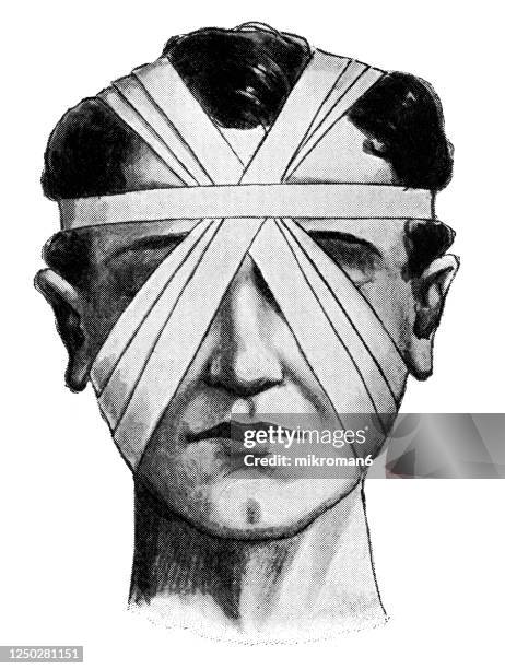 old engraved illustration of examples of approved modes of bandaging the head. - head bandage stock-fotos und bilder