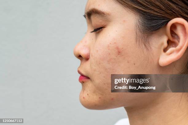 side view close-up of asian woman face has variety problems on her skin (such as acne, pimple, pores and melasma etc). - tinea foto e immagini stock