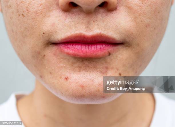 close-up of asian woman half-face has variety problems on her skin (such as acne, pimple, pores and melasma etc). - narbe hautmerkmal stock-fotos und bilder