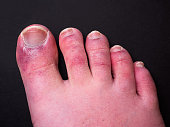 A man's toes showing what looks like a rash with red blotchy skin. A common side effect of Covid-19 often referred to as 