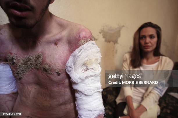 Goodwill Ambassador and Hollywood star, Angelina Jolie studies, 27 August 2007 in Damascus, Syria, the wounds of a burned Iraqi refugee, whose...