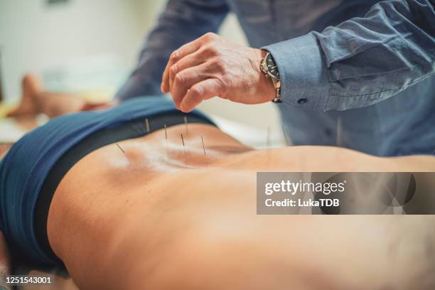not every needle prick is painful - agulha de acupuntura imagens e fotografias de stock
