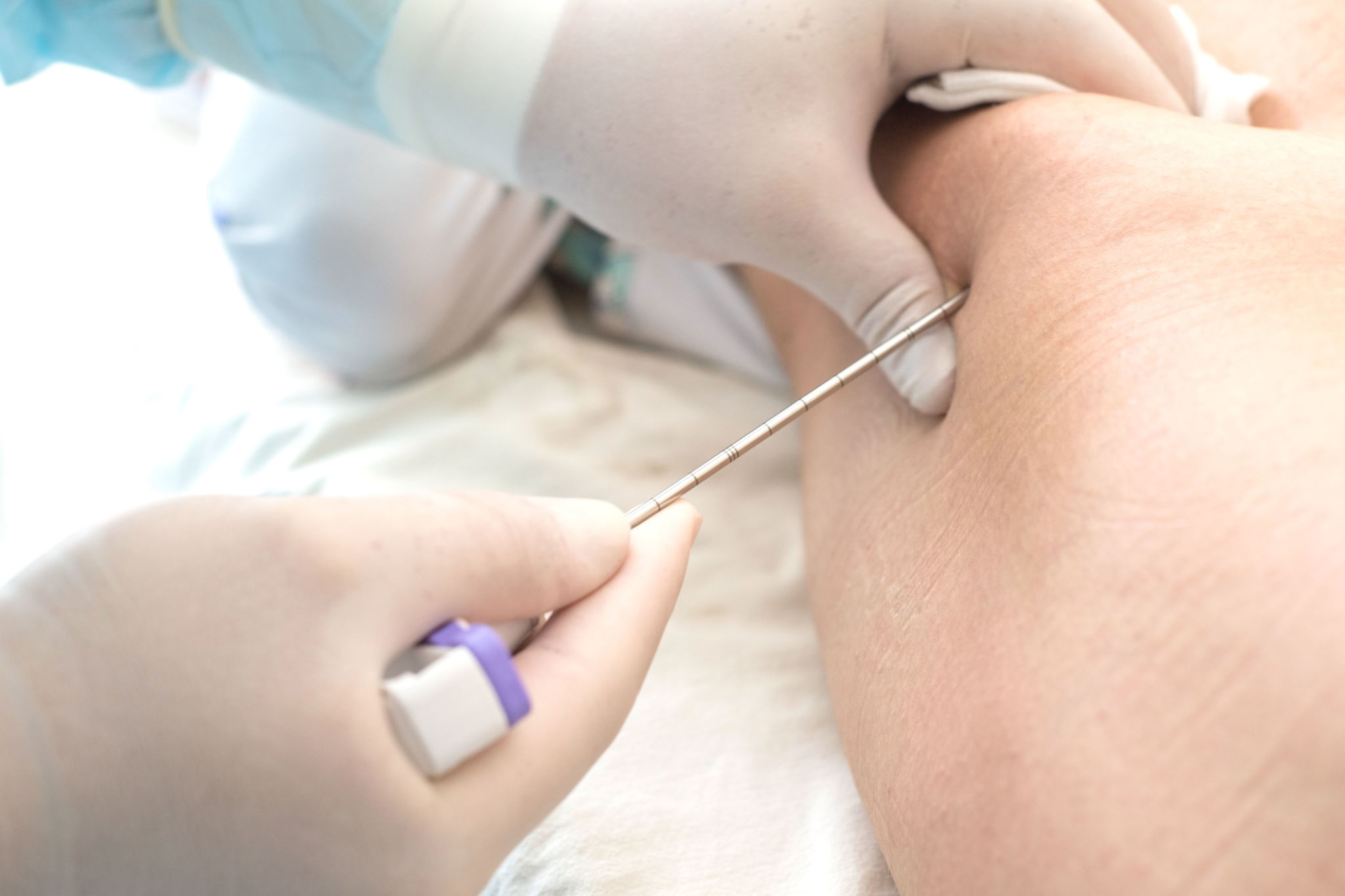 escleroterapia procedimento