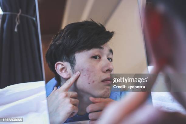 aziatische man kreeg een acne - puist stockfoto's en -beelden