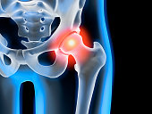 Painful hip joint - x-ray illustration