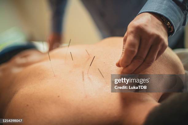 back acupuncture - acupuncture stock pictures, royalty-free photos & images