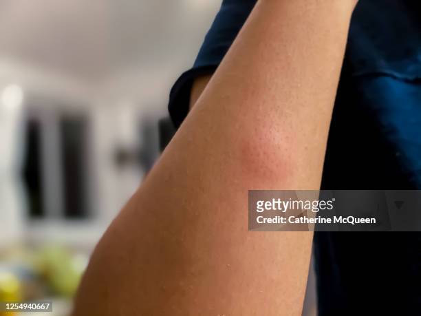 swollen mosquito bite on unrecognizable female’s arm - stinging stockfoto's en -beelden