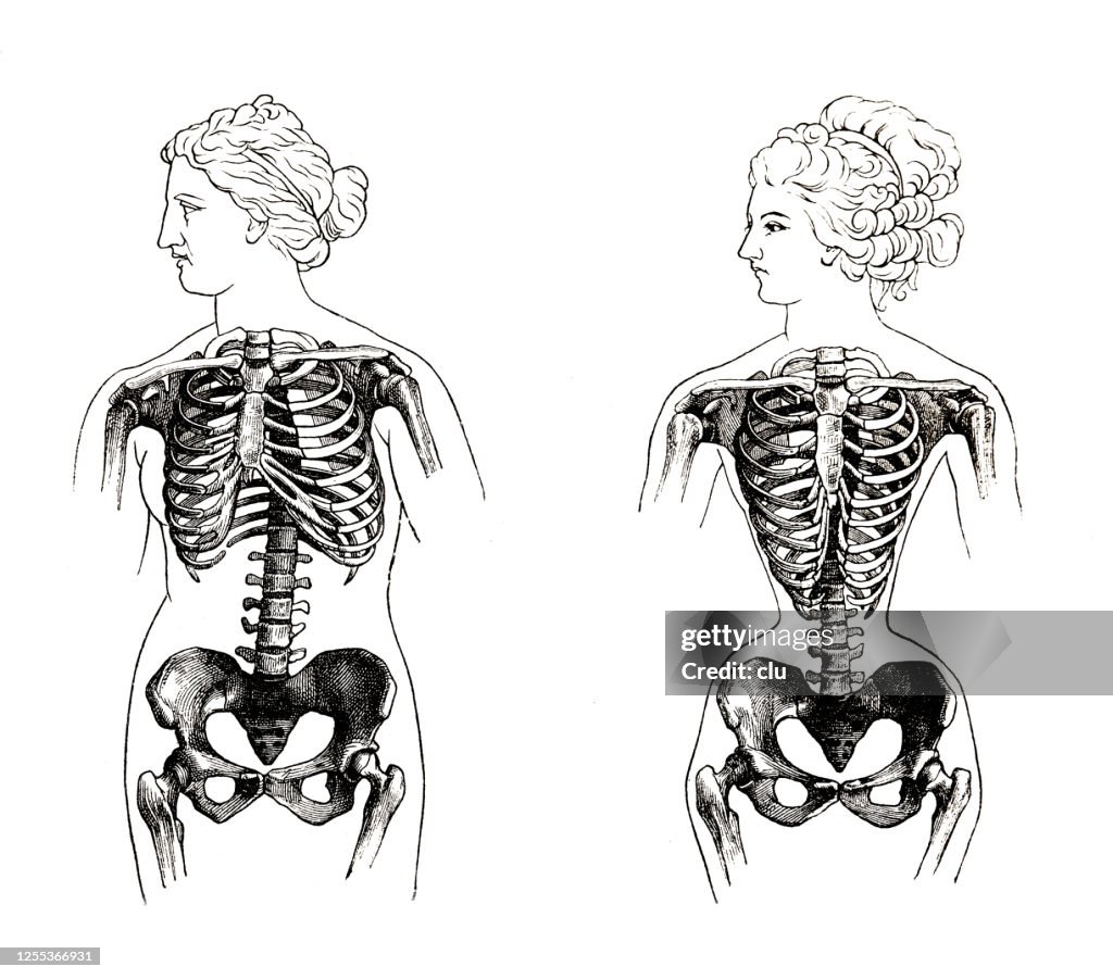 Woman 12th Rib Normal Female Rib Cage Compared To Rippled Due To Excessive Lacing High ...