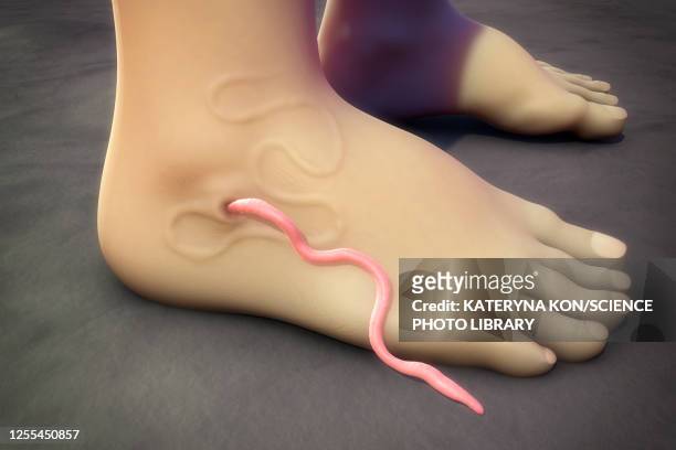 guinea worm emerging from infected foot, illustration - guinea worm stock illustrations