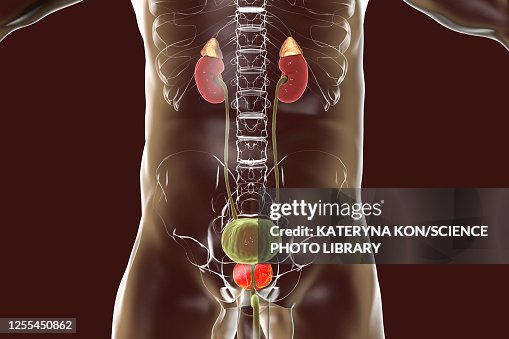 Benign prostatic hyperplasia, illustration Benign prostatic hyperplasia, illustration