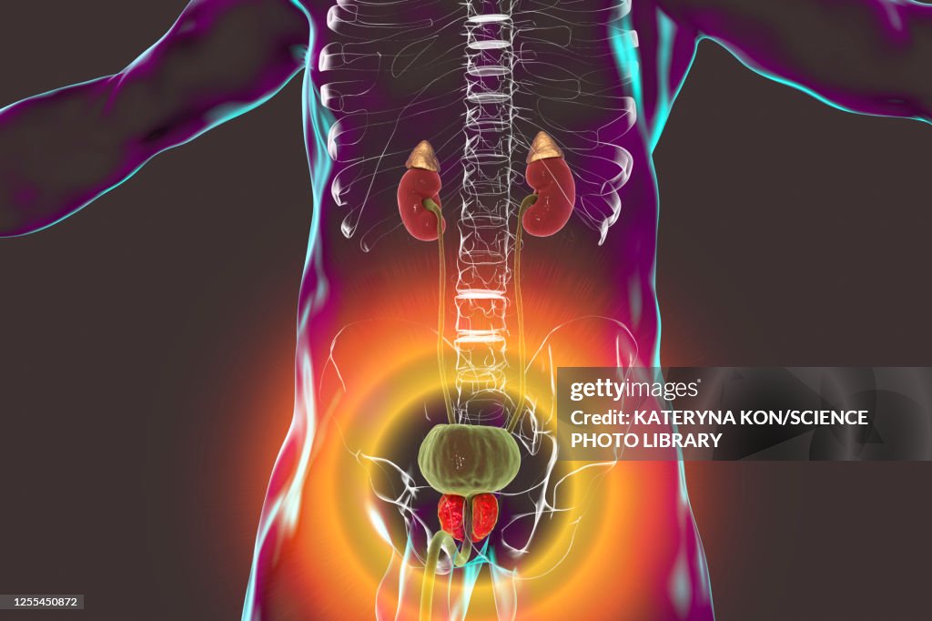 Benign prostatic hyperplasia, illustration