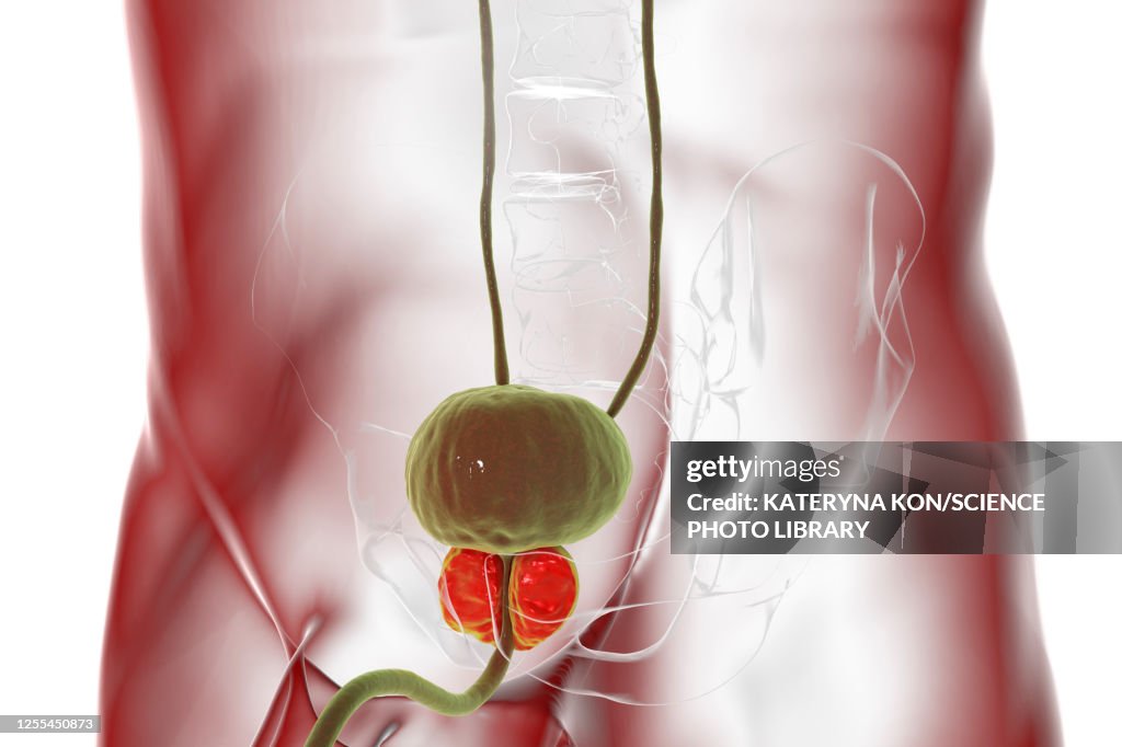 Benign prostatic hyperplasia, illustration