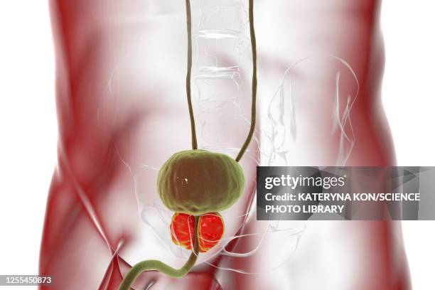 benign prostatic hyperplasia, illustration - prostate cancer stock illustrations