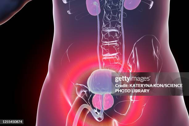 benign prostatic hyperplasia, illustration - blase harnapparat stock-grafiken, -clipart, -cartoons und -symbole