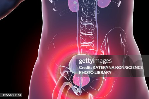 Benign prostatic hyperplasia, illustration Benign prostatic hyperplasia, illustration