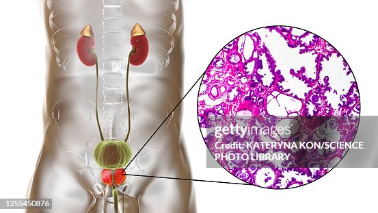 Benign prostatic hyperplasia, illustration and micrograph Benign prostatic hyperplasia, illustration and micrograph