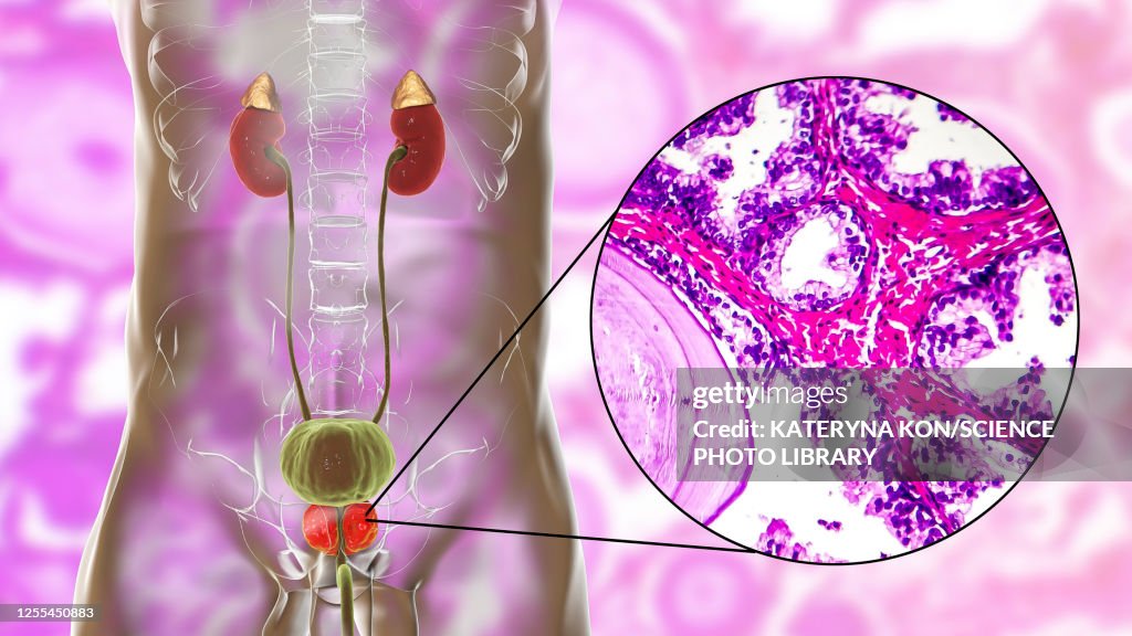 Benign prostatic hyperplasia, illustration and micrograph