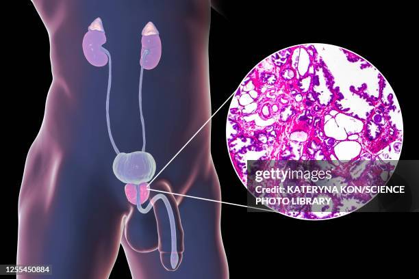 benign prostatic hyperplasia, illustration and micrograph - 光学顕微鏡図点のイラスト素材／クリップアート素材／マンガ素材／アイコン素材