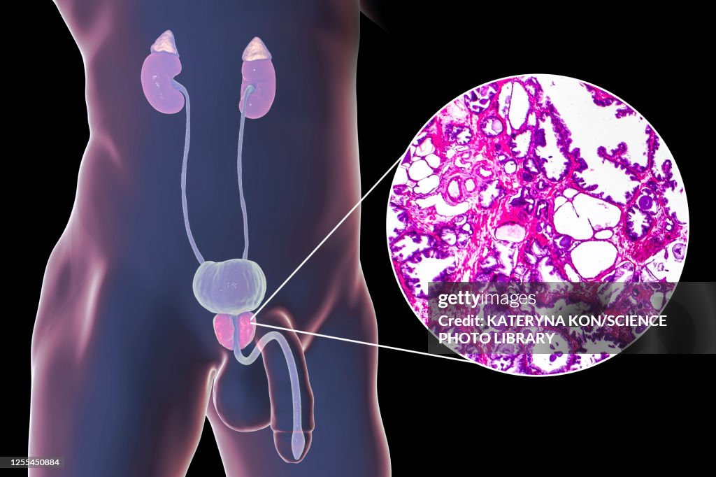 Benign prostatic hyperplasia, illustration and micrograph