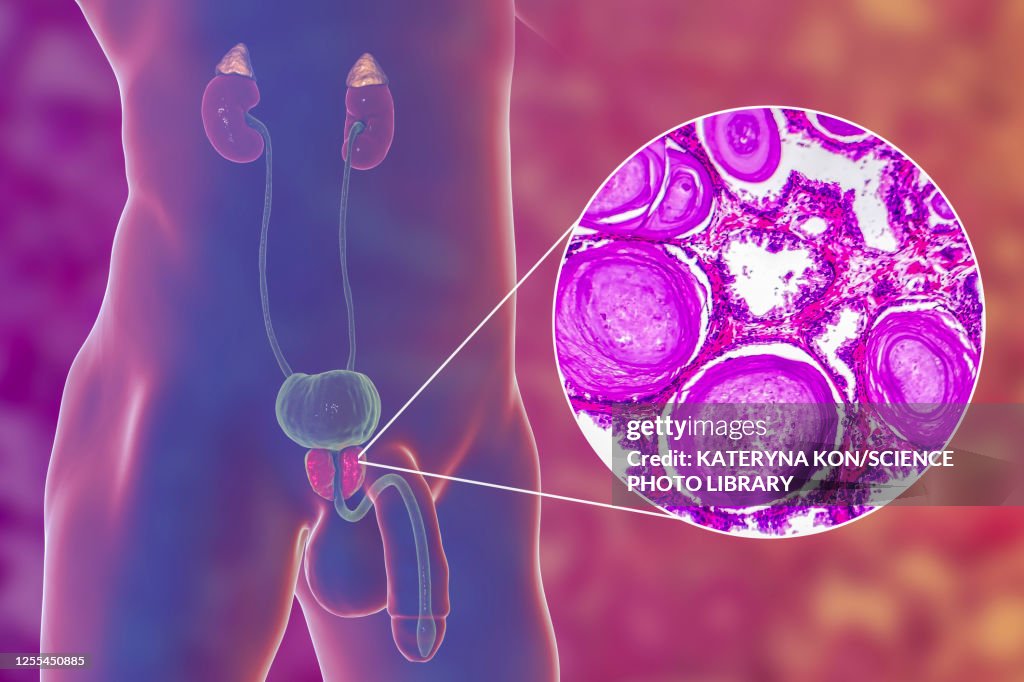 Benign prostatic hyperplasia, illustration and micrograph