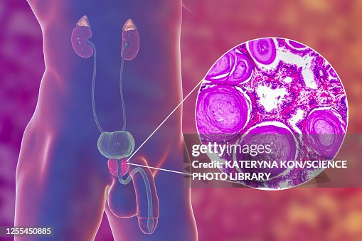 Benign prostatic hyperplasia, illustration and micrograph Benign prostatic hyperplasia, illustration and micrograph