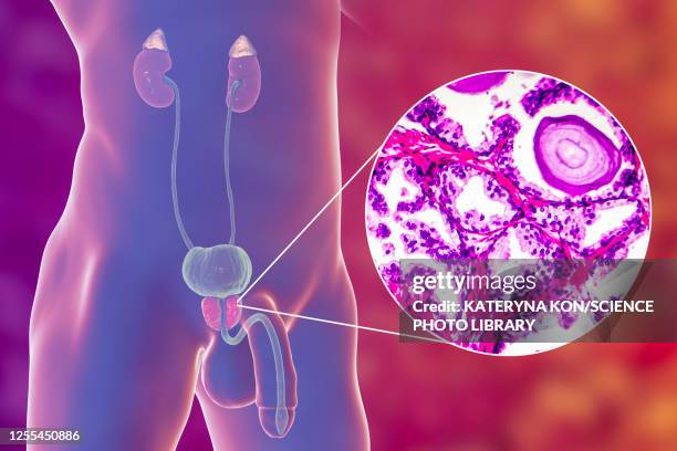 benign prostatic hyperplasia, illustration and micrograph - adrenal hyperplasia stock illustrations