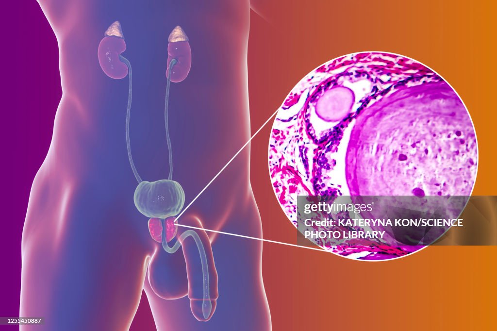 Benign prostatic hyperplasia, illustration and micrograph