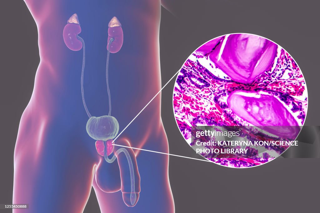 Benign prostatic hyperplasia, illustration and micrograph